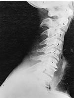 spinal degeneration